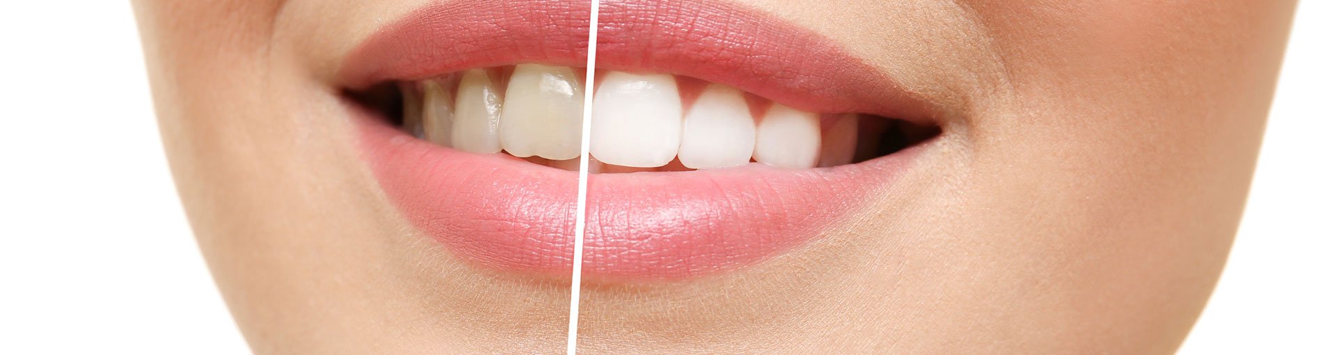 teeth whitening before and after smile