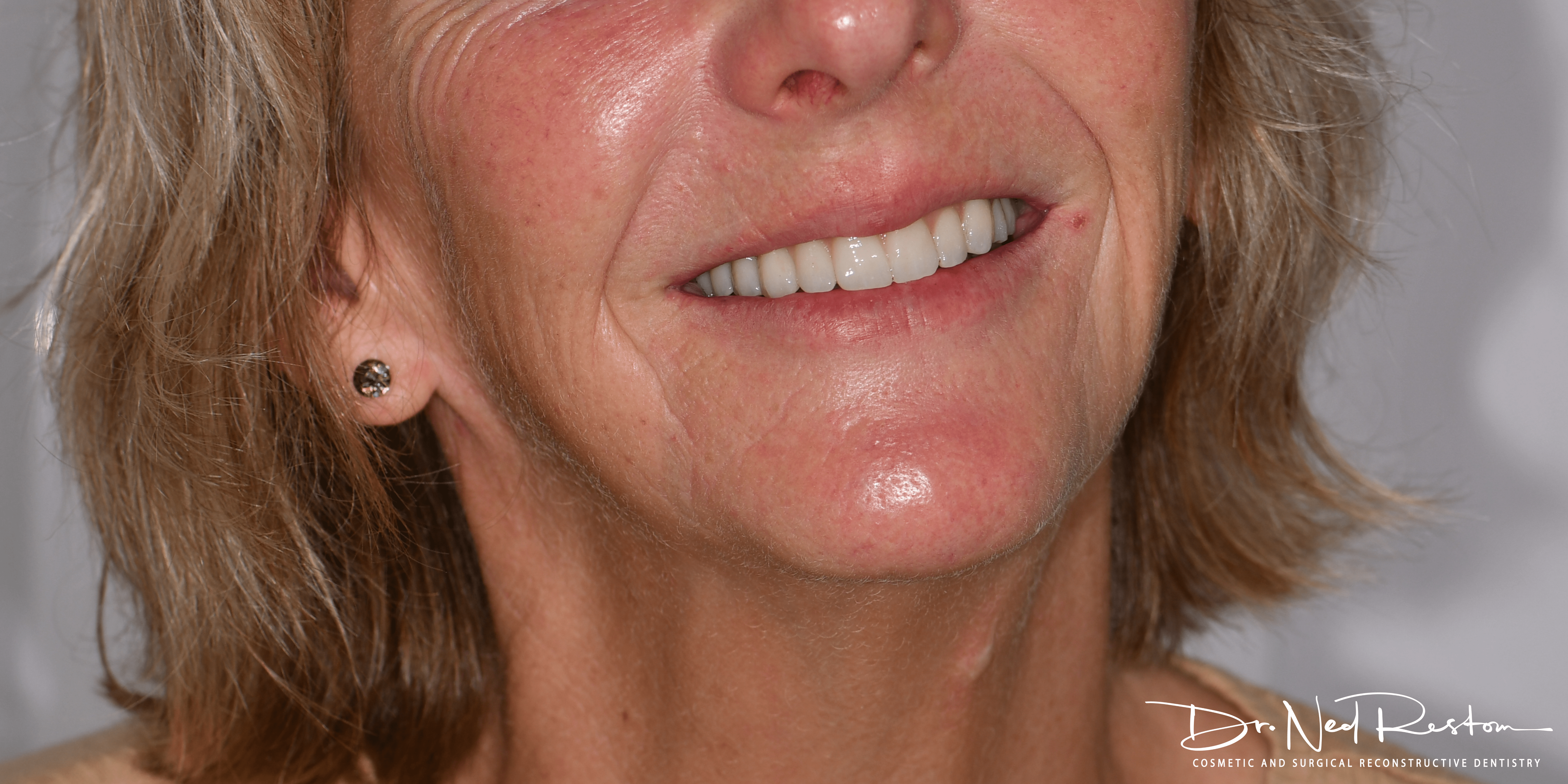 teeth on implants lady